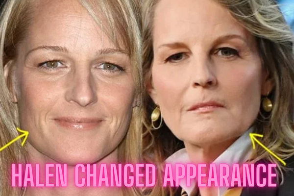 helen hunt plastic surgery